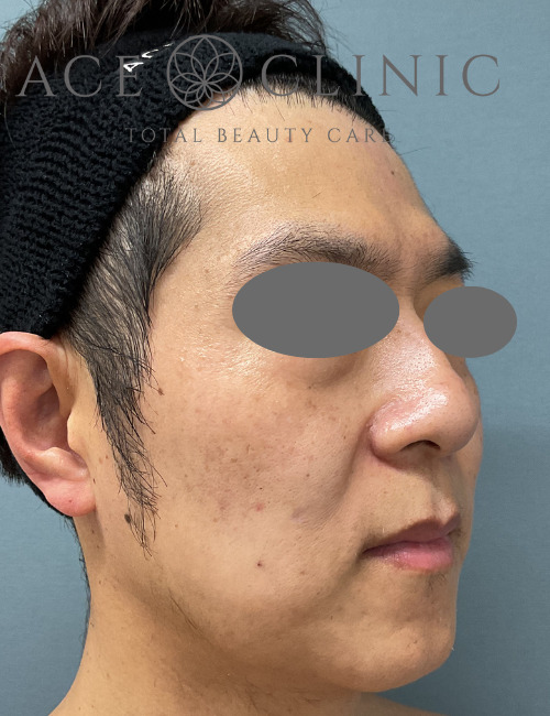 ルビーレーザー症例