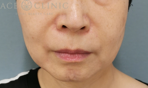 ヒアルロン酸注入｜ほうれい線｜症例47｜女性｜術後｜エースクリニック大阪梅田HEPナビオ院