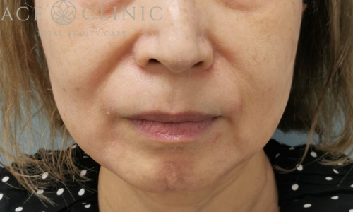 ヒアルロン酸注入｜ほうれい線｜症例47｜女性｜術前｜エースクリニック大阪梅田HEPナビオ院