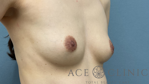 脂肪豊胸-中山医師