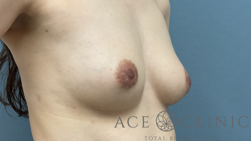 脂肪豊胸-中山医師