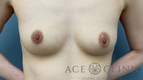 脂肪豊胸-中山医師