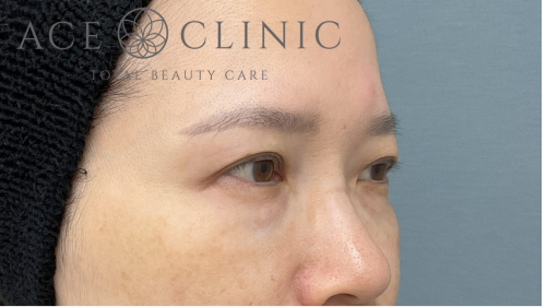 脱脂CRF法症例-中山医師