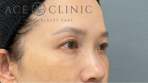 脱脂CRF法症例-中山医師