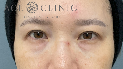 脱脂CRF法症例-中山医師