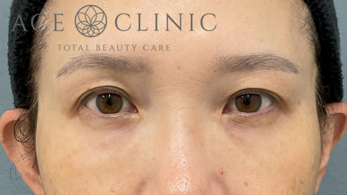 脱脂CRF法症例-中山医師