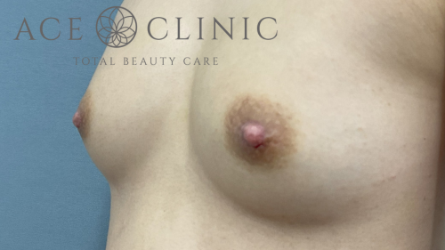 乳頭縮小症例-中山医師