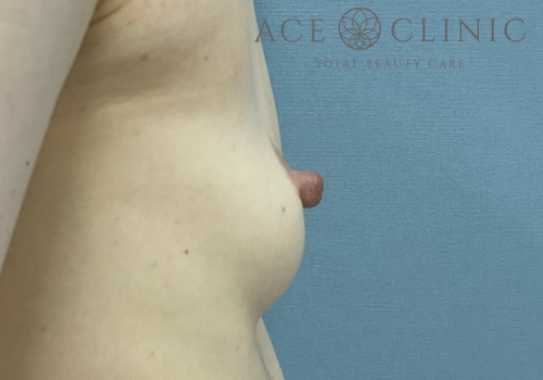 乳頭縮小症例-中山医師