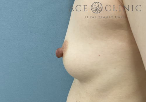 乳頭縮小症例-中山医師