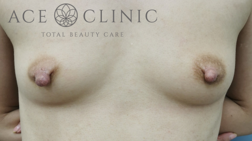 乳頭縮小症例-中山医師