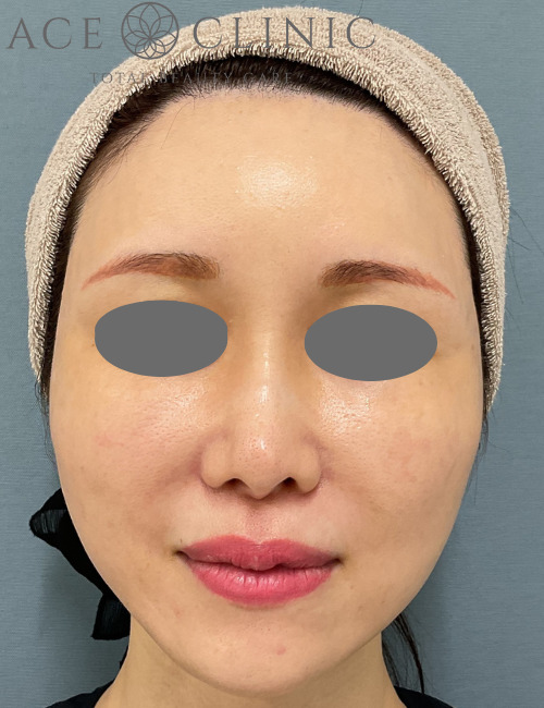 ショッピングリフト症例-宇根医師