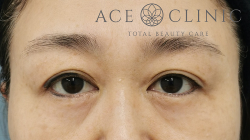 眉毛下切開法-中山医師