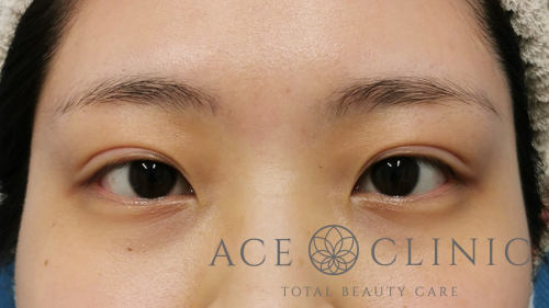 スーパープレミアム埋没法3点留め症例-谷医師