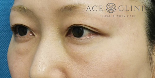 経結膜ハムラ法症例-谷医師