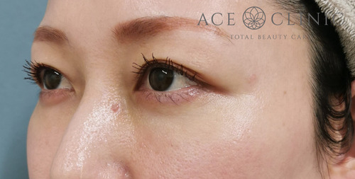 経結膜ハムラ法症例-谷医師