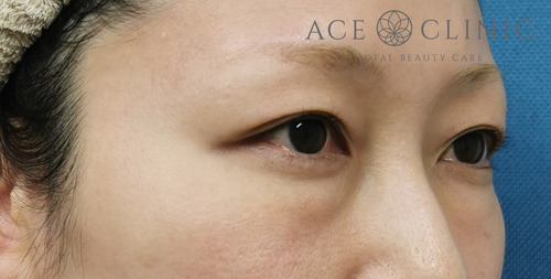 経結膜ハムラ法症例-谷医師