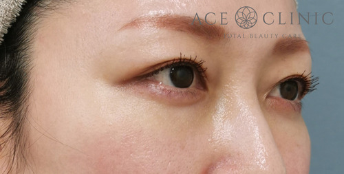 経結膜ハムラ法症例-谷医師