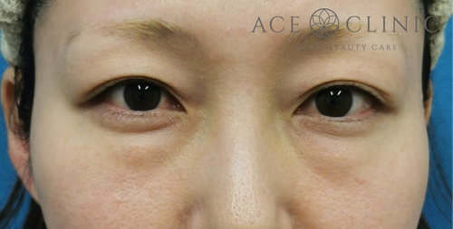 経結膜ハムラ法症例-谷医師