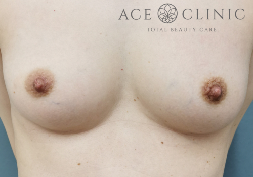 乳頭縮小症例-中山医師