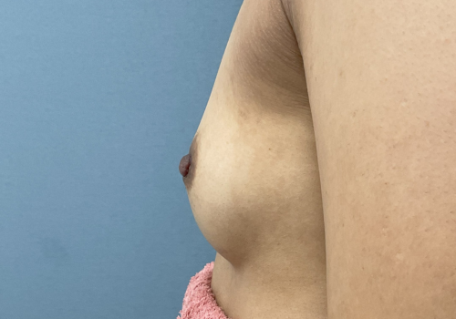 乳頭縮小症例-中山医師