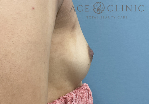 乳頭縮小症例-中山医師