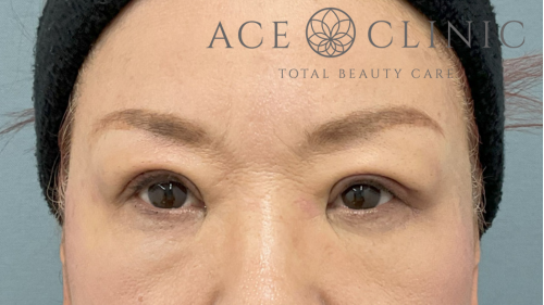 眼瞼挙筋前転法症例-中山医師