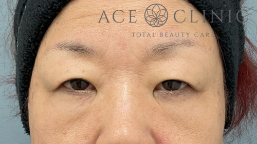 眼瞼挙筋前転法症例-中山医師