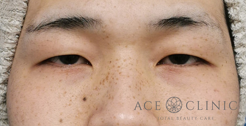 眼瞼挙筋前転法-谷医師