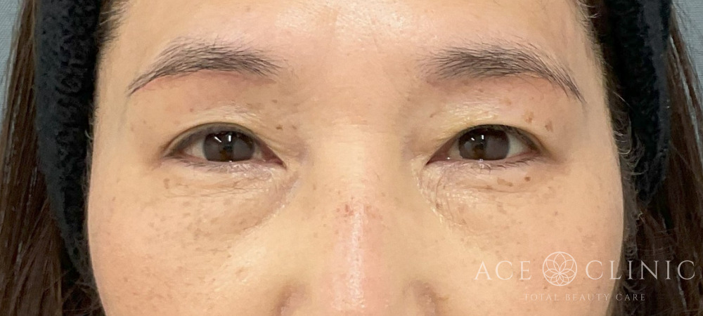 眉毛下切開法-中山