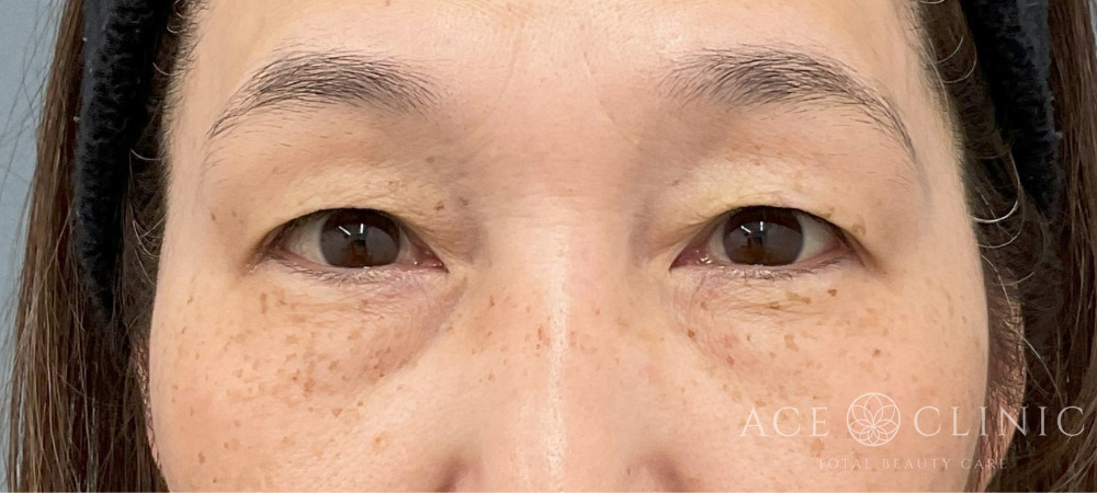 眉毛下切開法-中山