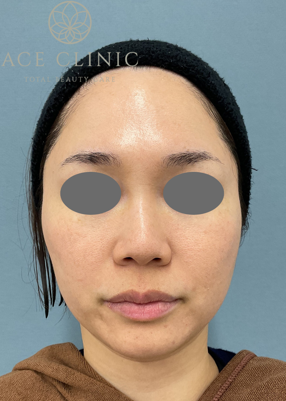 ララピール症例-看護師施術