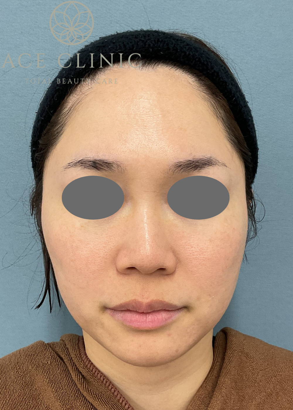 ララピール症例-看護師施術