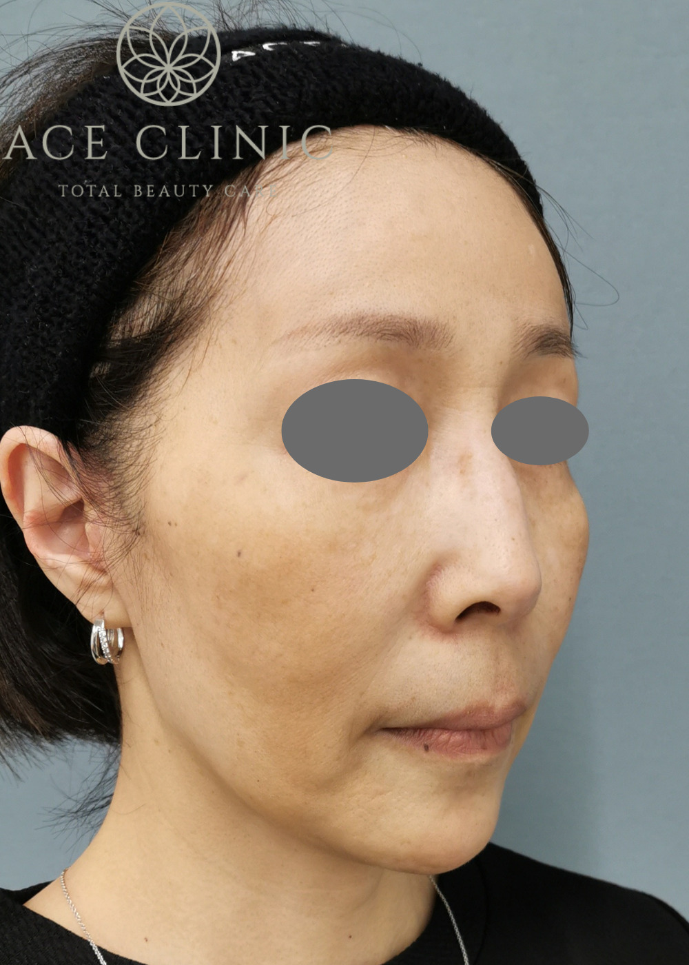 macsリフト-谷院長