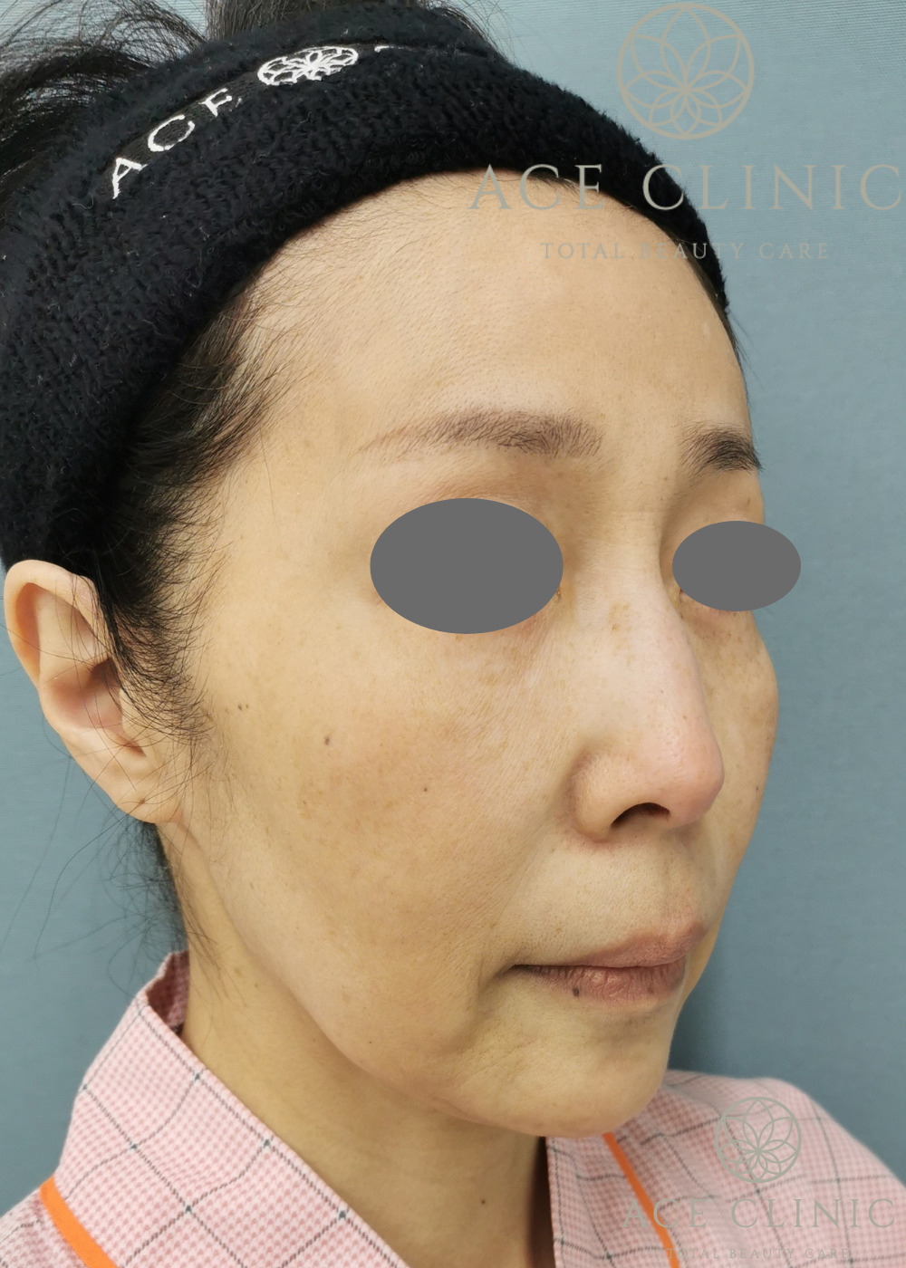 macsリフト-谷院長