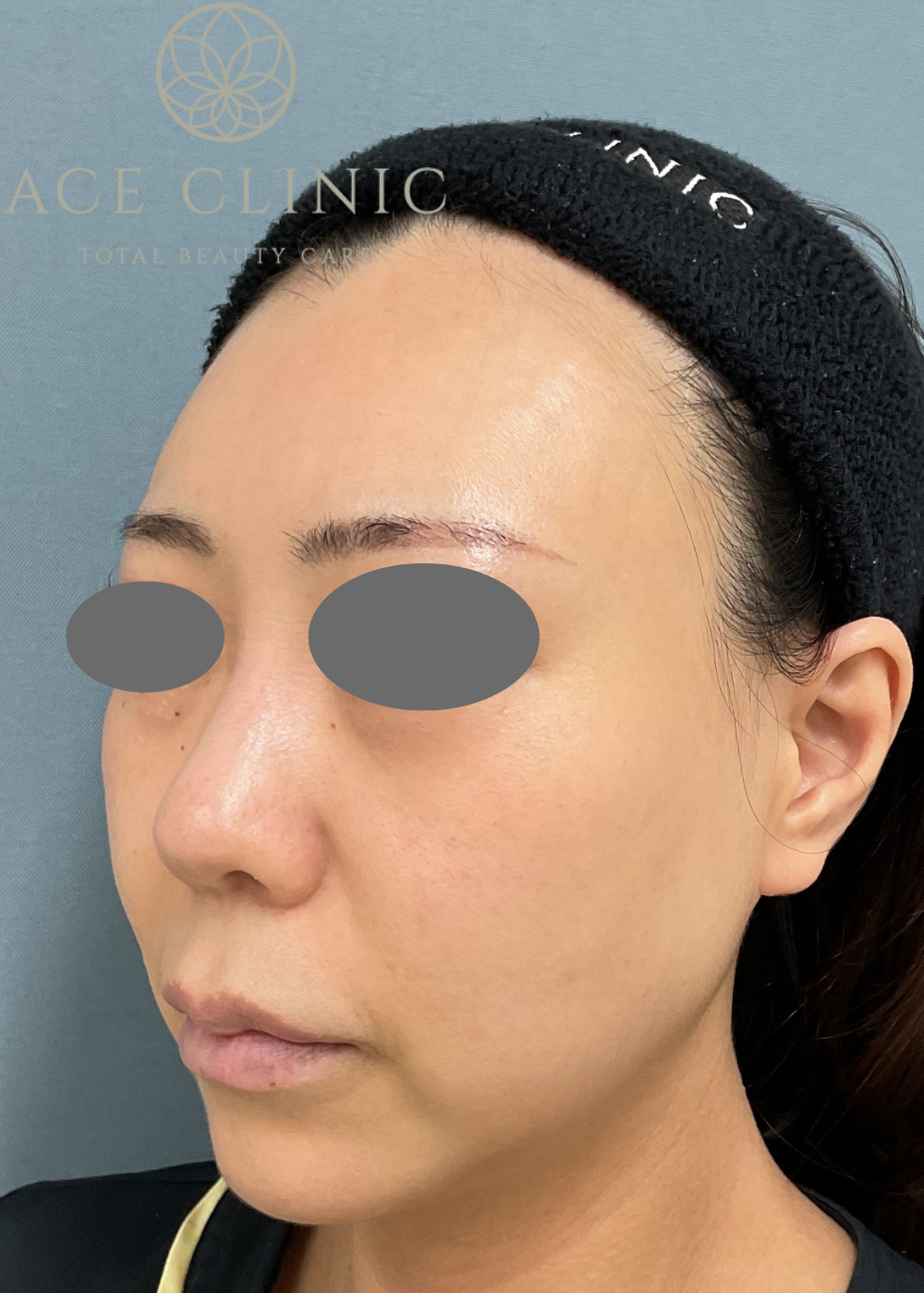 ショートスレッド症例-看護師