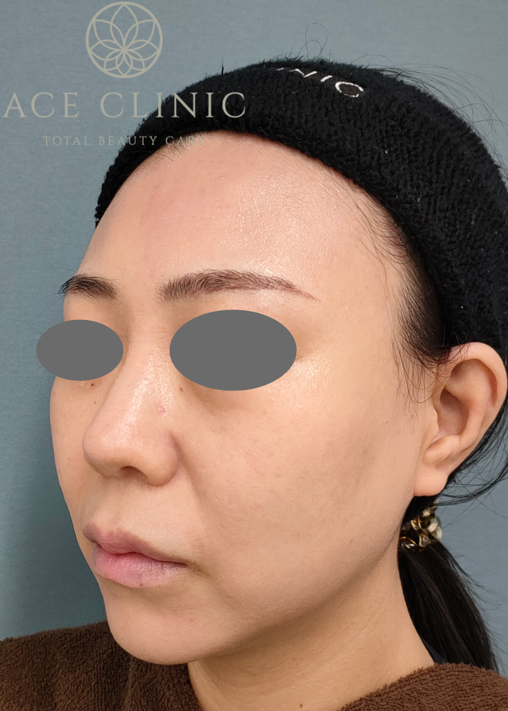 ショートスレッド症例-看護師