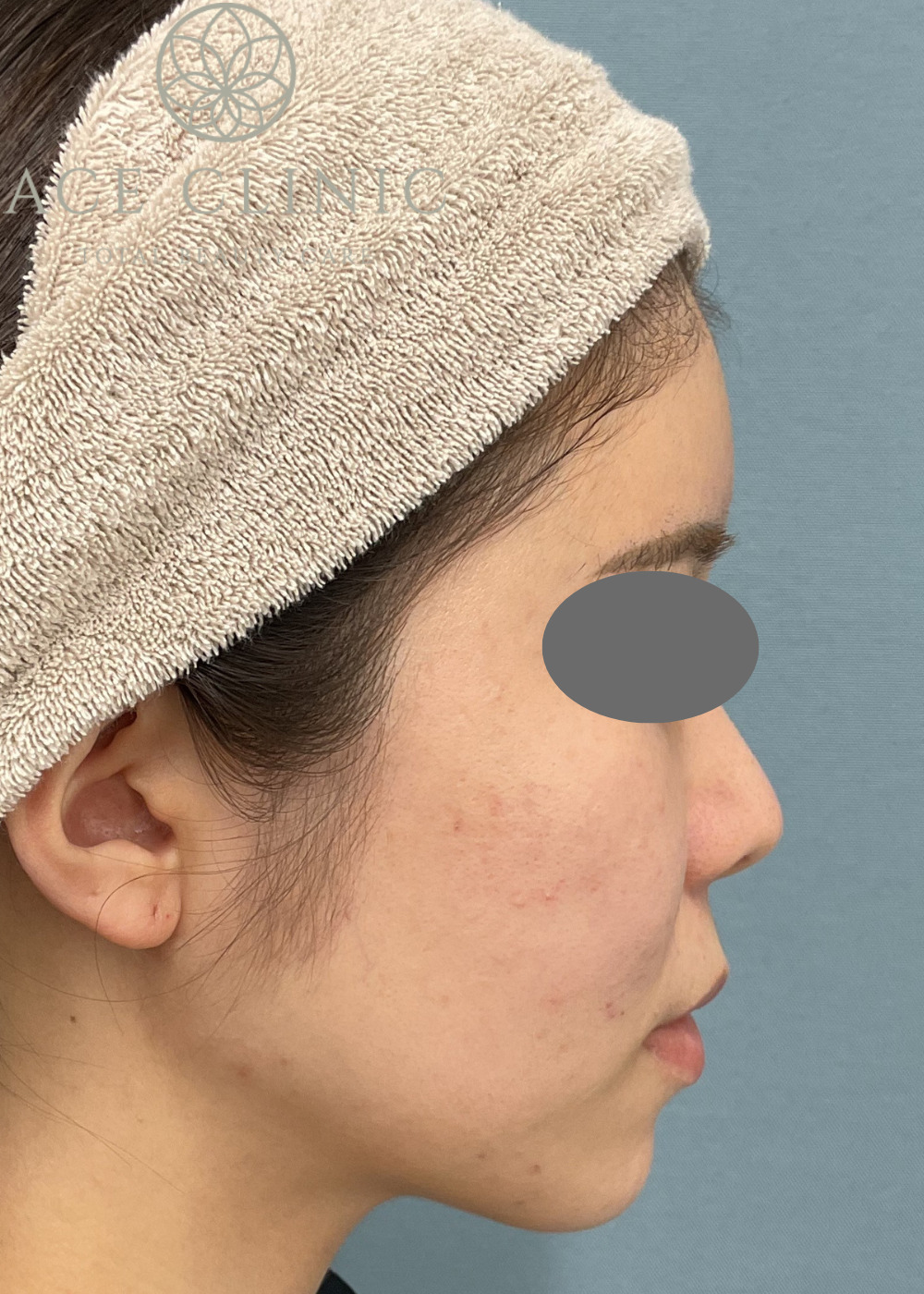 ボルニューマ症例