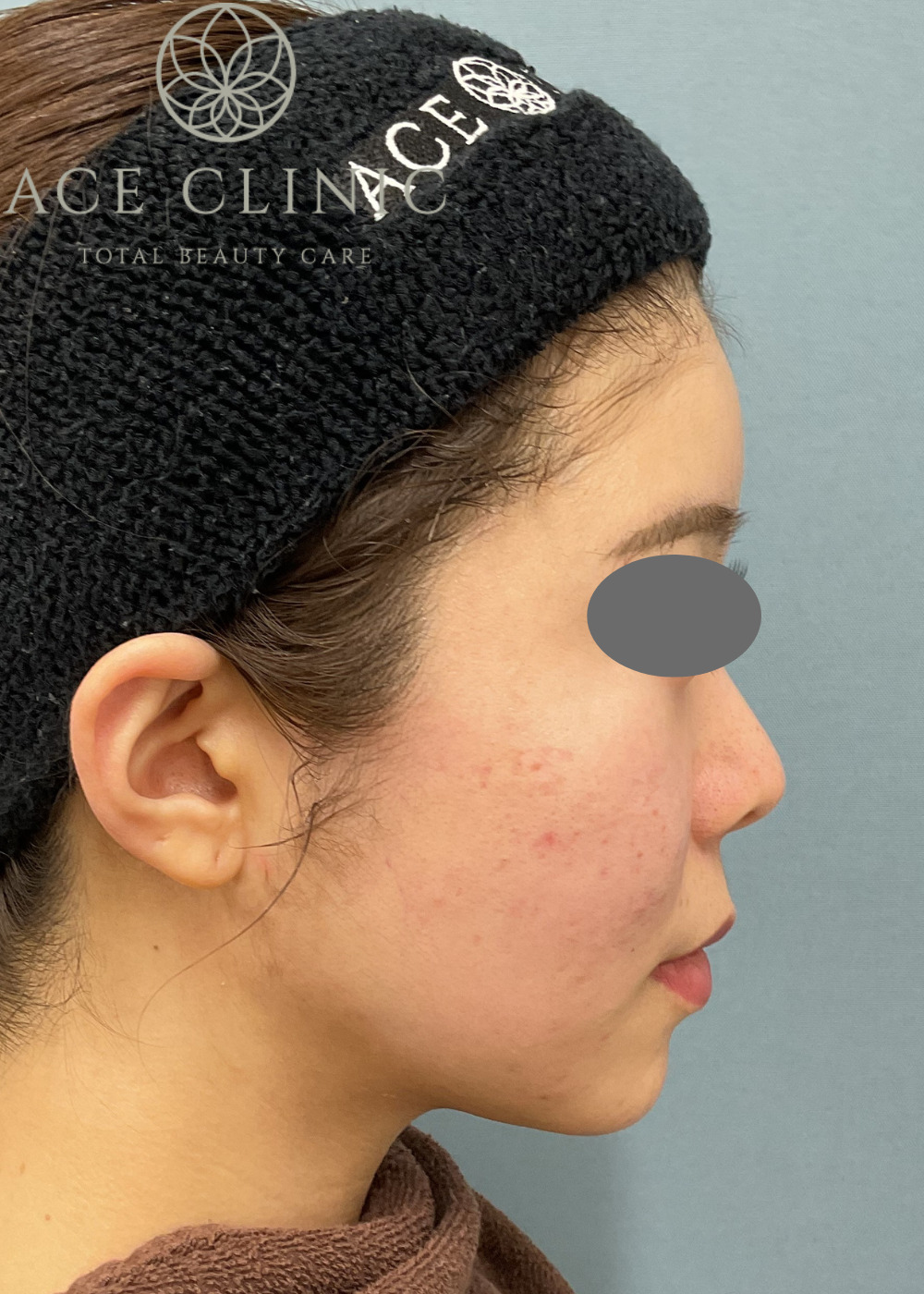 ボルニューマ症例