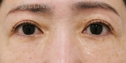 脱脂CRF+眉毛下切開法|症例2|50代女性|術後3ヶ月|エースクリニック大阪梅田HEPナビオ院