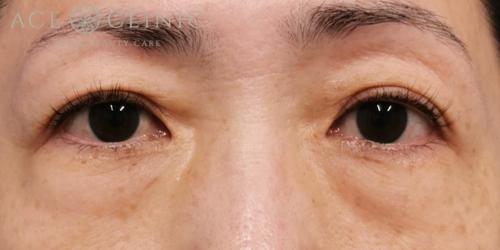 脱脂CRF+眉毛下切開法|症例2|50代女性|術前|エースクリニック大阪梅田HEPナビオ院