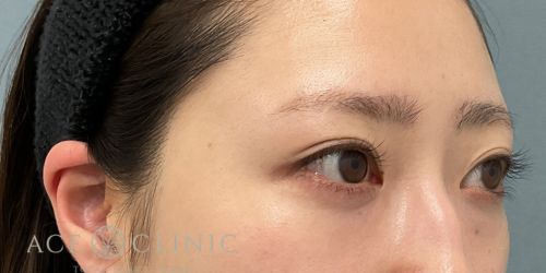 経結膜ハムラ法 症例59 24歳女性 術後1年 エースクリニック大阪梅田HEPナビオ院