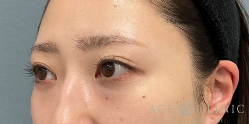 経結膜ハムラ法 症例59 24歳女性 術後1年 エースクリニック大阪梅田HEPナビオ院