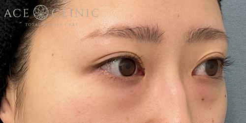 経結膜ハムラ法|症例59|24歳女性|術前|エースクリニック大阪梅田HEPナビオ院