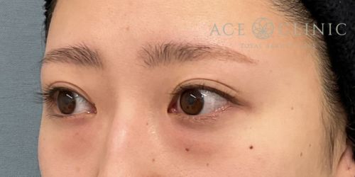 経結膜ハムラ法 症例59 24歳女性 術前 エースクリニック大阪梅田HEPナビオ院