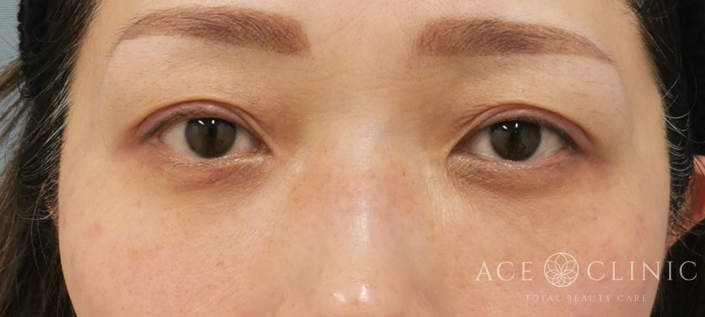 経結膜ハムラ法｜症例60｜47歳女性｜術後3ヶ月｜エースクリニック大阪梅田HEPナビオ院