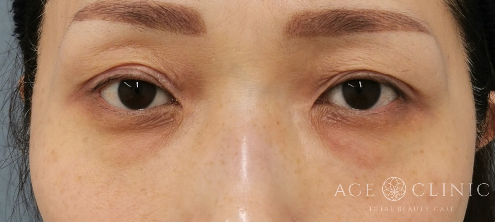 経結膜ハムラ法｜症例60｜47歳女性｜術前｜エースクリニック大阪梅田HEPナビオ院