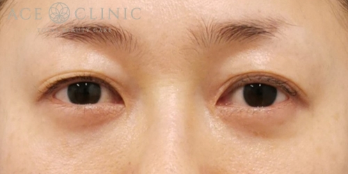 経結膜ハムラ法|症例61|40代女性|術後3ヶ月|エースクリニック大阪梅田HEPナビオ院