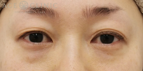 経結膜ハムラ法|症例61|40代女性|術前|エースクリニック大阪梅田HEPナビオ院