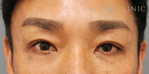 二重全切開｜症例17｜40代男性｜術後1ヶ月｜エースクリニック大阪梅田HEPナビオ院