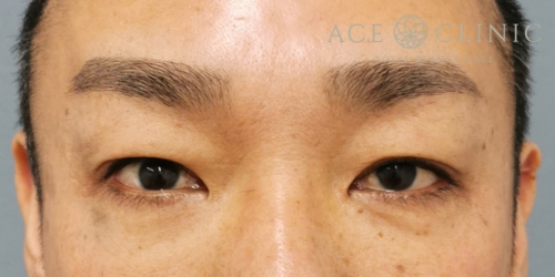 二重全切開|症例17|40代男性|術前|エースクリニック大阪梅田HEPナビオ院